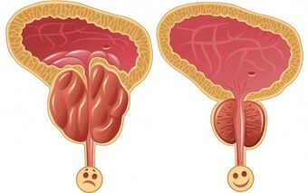 How ProstEro prostatitis works before and after treatment