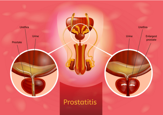 prostatitis