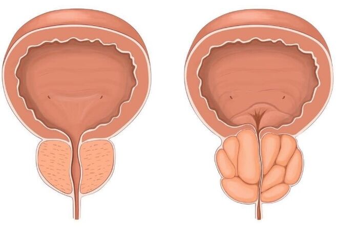prostatitis