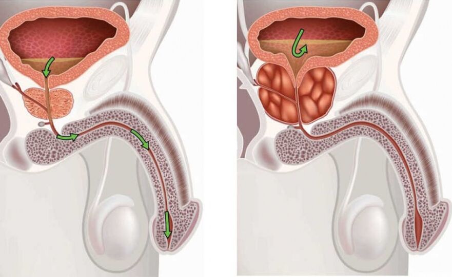 Healthy and diseased prostate in men