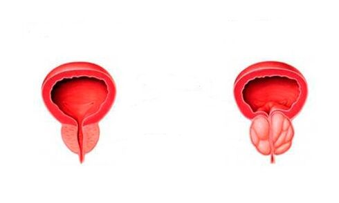 Healthy and inflammatory prostate with prostatitis