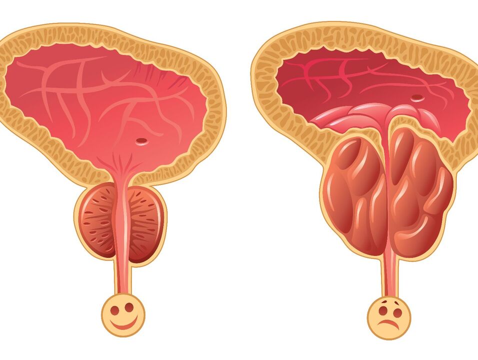 Healthy prostate gland and prostate swelling with congestive prostatitis
